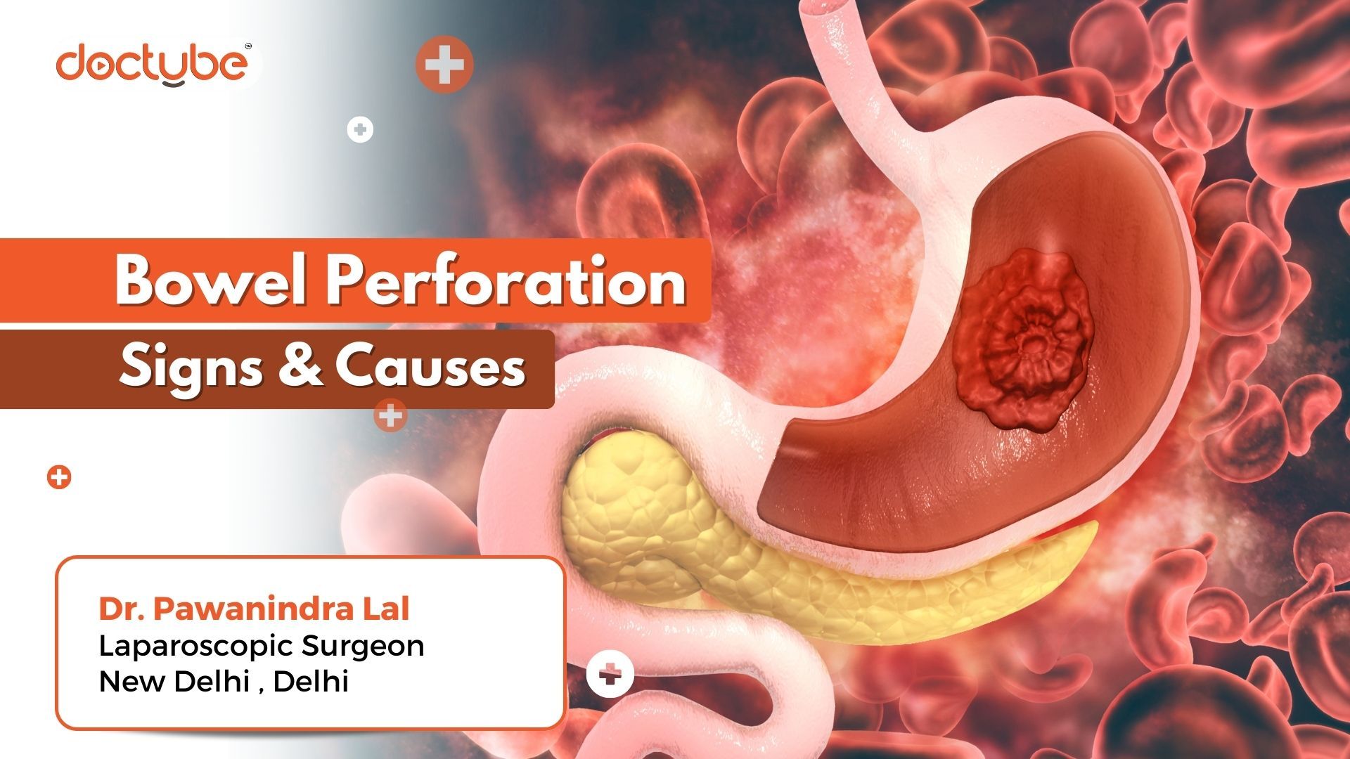 bowel-perforation-signs-and-causes